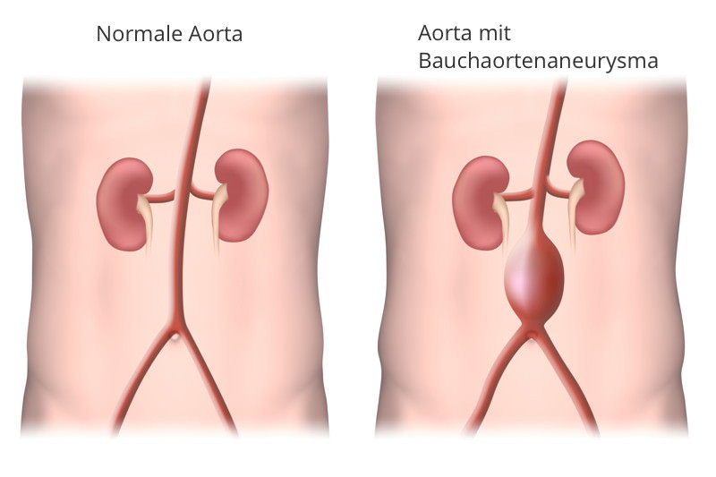 Bauchaortenaneurysma Bauchaortenaneurysma, Abdominelles Aortenaneurysma, Aneurysma der Bauchaorta