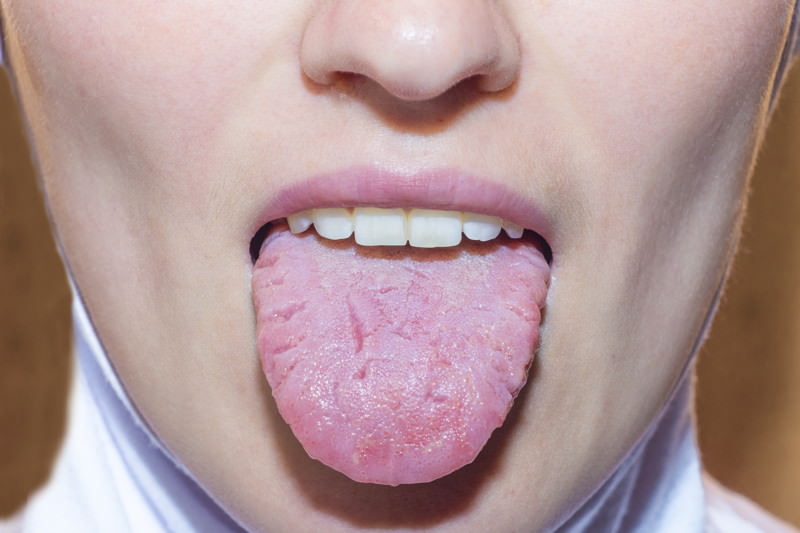 Belegte Zunge, Zungenbelag