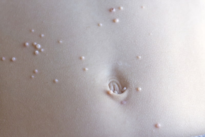 Dellwarzen, Mollusken, Epithelioma contagiosum, Epithelioma molluscum, Mollusca contagiosa