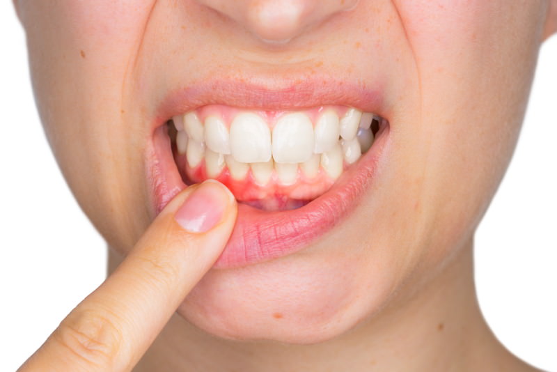 Gingivitis (Zahnfleischentzündung) Gingivitis, Zahnfleischentzündung