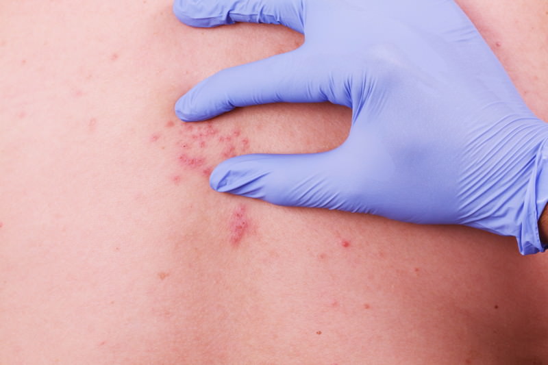 Gürtelrose, Herpes zoster, Shingles, Zosterneuritis, Zosterradikulitis