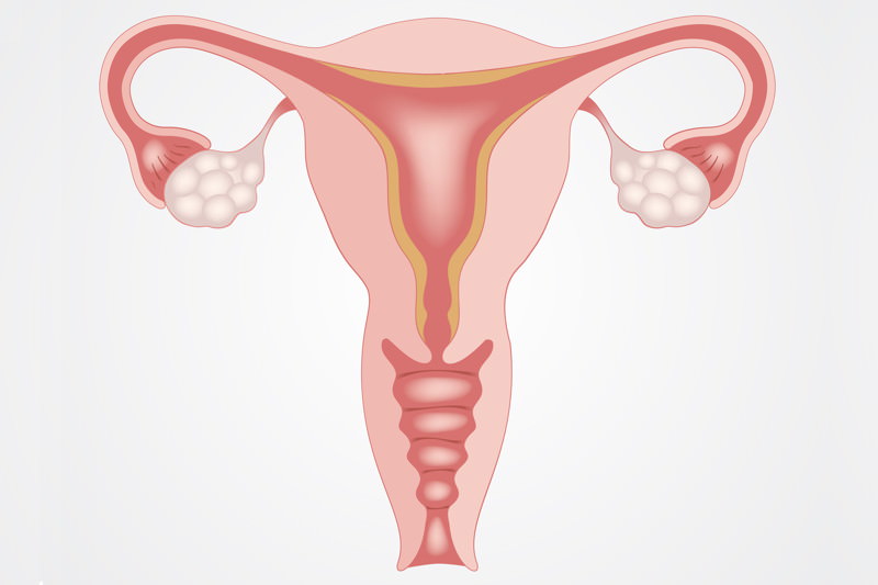 Hysterektomie, Gebärmutterentfernung, Uterusexstirpation