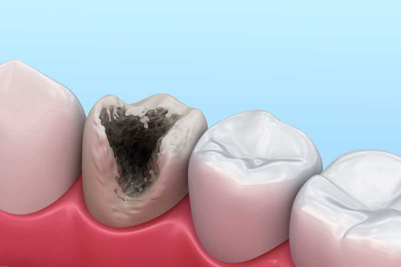 Karies, Caries, Zahnfäule, Zahnfäulnis, Zahnkaries