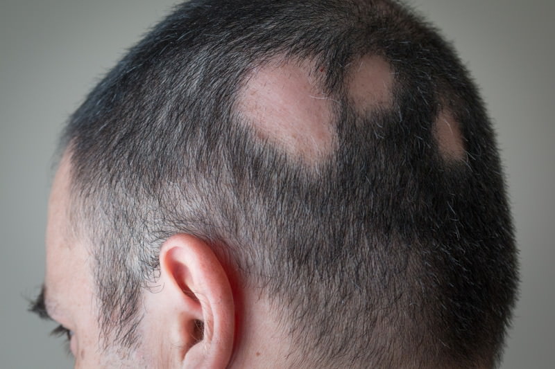 Alopecia areata, Kreisrunder Haarausfall