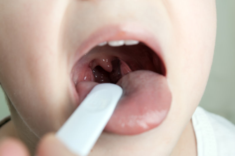 Mandelentzündung (Tonsillitis) Mandelentzündung, Tonsillitis, Angina tonsillaris