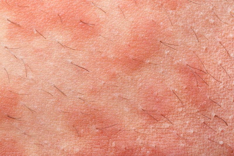Neurodermitis Neurodermitis, Atopische Dermatitis, Atopisches Ekzem, Endogenes Ekzem, Konstitutionelles Ekzem