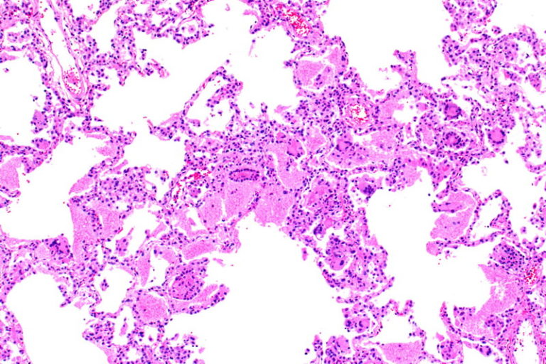 Pneumocystis jirovecii Krankheiten und Vorbeugung des Erregers eMEDI