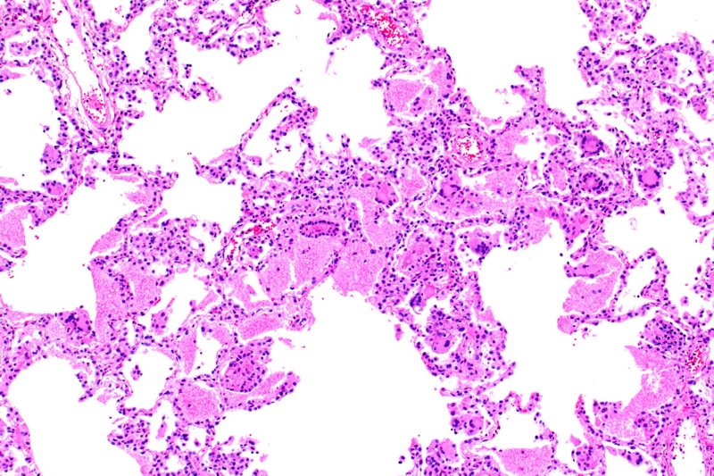 Pneumocystis jirovecii Pneumocystis jirovecii, Pneumocystis carinii