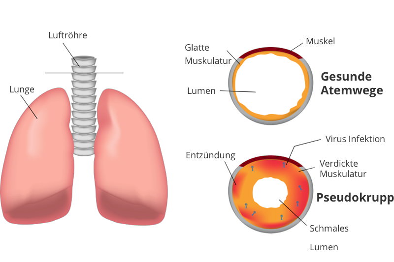 Pseudokrupp, Stenosierende Laryngitis, Subglottische Laryngitis, Viraler Krupp