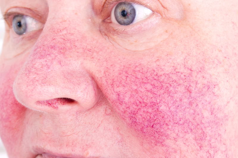 Rosacea, Couperos, Kupferfinne, Kupferrose, Rosenfinne, Rotfinnen