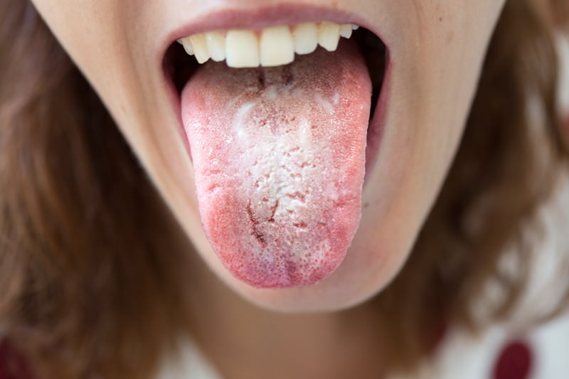 Soor (Candidose) Soor, Candidose, Candida-Mykosen, Kandidose, Soorgranulom, Soormykosen